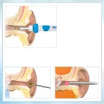 EARSIO